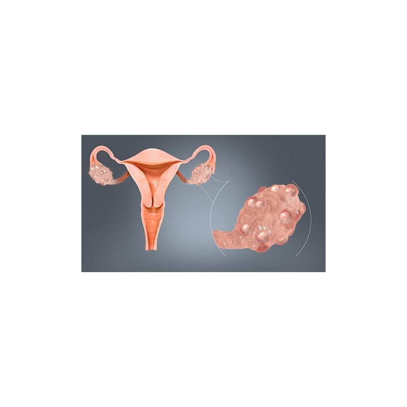 Read more about the article A GLANCE AT PCOD/PCOS AND MORE.?