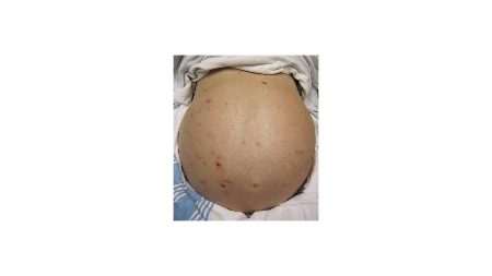 Read more about the article 🌊 What Is Ascites?