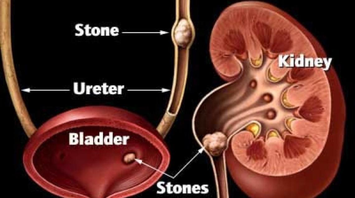 Read more about the article Urinary Bladder Stones: Causes, Treatments.