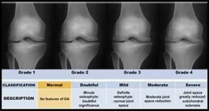Read more about the article बुजुर्गों सर्दियों में घुटने के दर्द ?