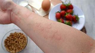 Read more about the article What Are Allergies?Causes, Symptoms.