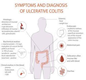 Read more about the article Homeopathic Remedies for Chronic Mucus Bleeding Ulcerative Colitis