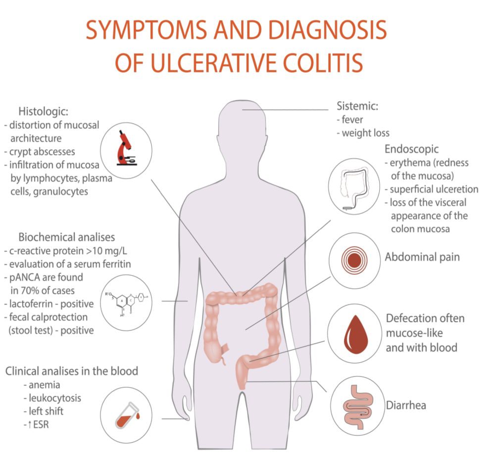Read more about the article Homeopathic Remedies for Chronic Mucus Bleeding Ulcerative Colitis