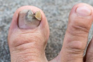 Read more about the article Nail Fungus,Fingernail fungus.